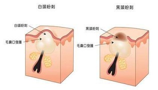 天津治疗青春痘的方法