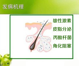 青春痘病因